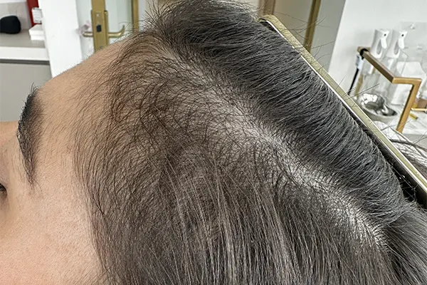 Img-Dra_Alexandra_Salazar-Antes&Despues-4-Despues