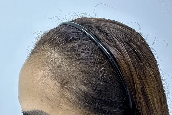 Img-Dra_Alexandra_Salazar-Antes&Despues-5-Antes