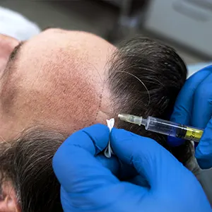 Img-clinica-capilar-en-medellin-Procedimientos-PRP-LCP