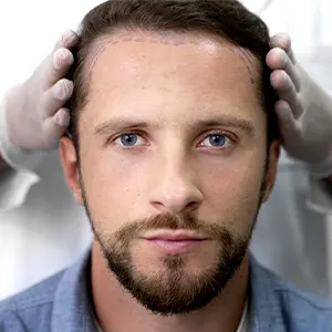 Img-clinica-capilar-en-medellin-Procedimientos-Transplante-LCP